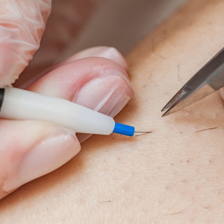 Electrolysis in hawthorn 1